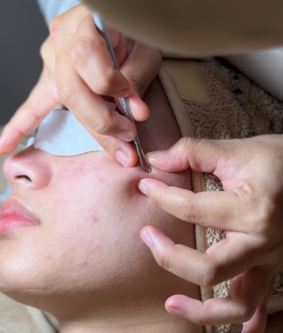Basic Acne Treatment